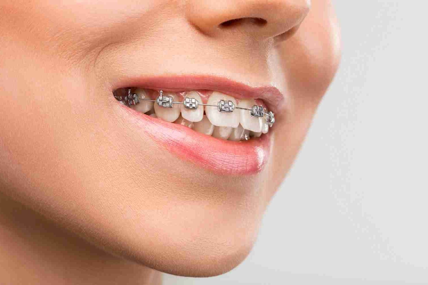 conventional braces 2 e1767208844256