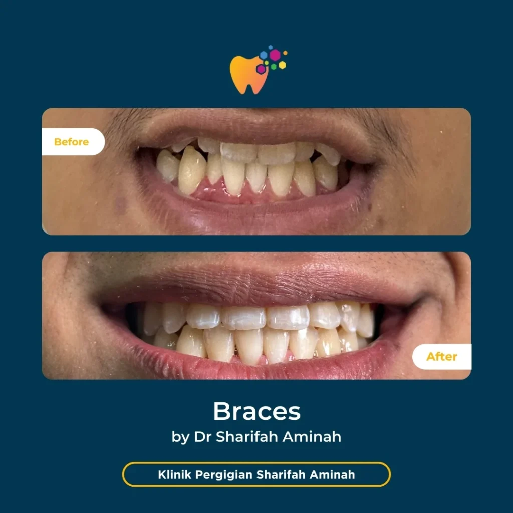 Kes rawatan braces pesakit Setiawangsa di Klinik Pergigian Sharifah Aminah menunjukkan perubahan susunan gigi sebelum dan selepas rawatan.