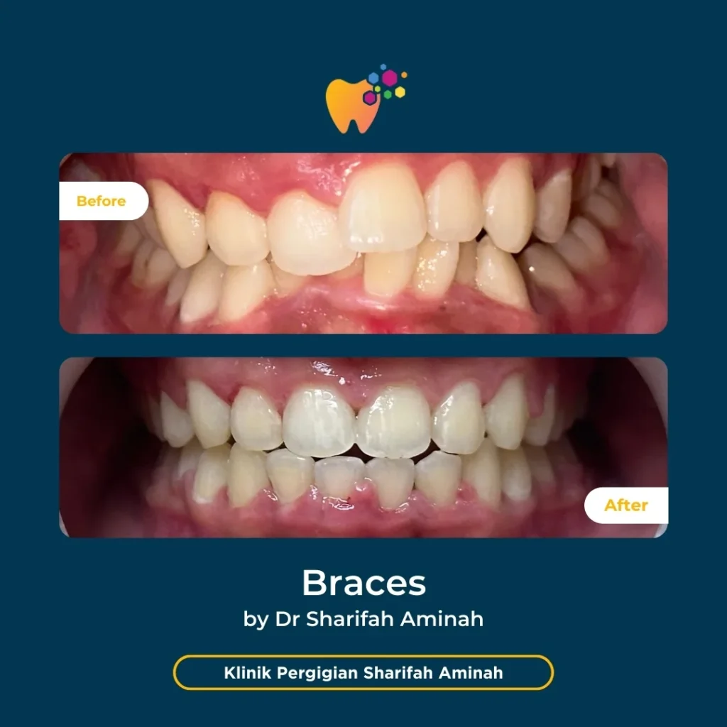 Kes rawatan braces pesakit Setiawangsa di Klinik Pergigian Sharifah Aminah menunjukkan perubahan susunan gigi sebelum dan selepas rawatan.