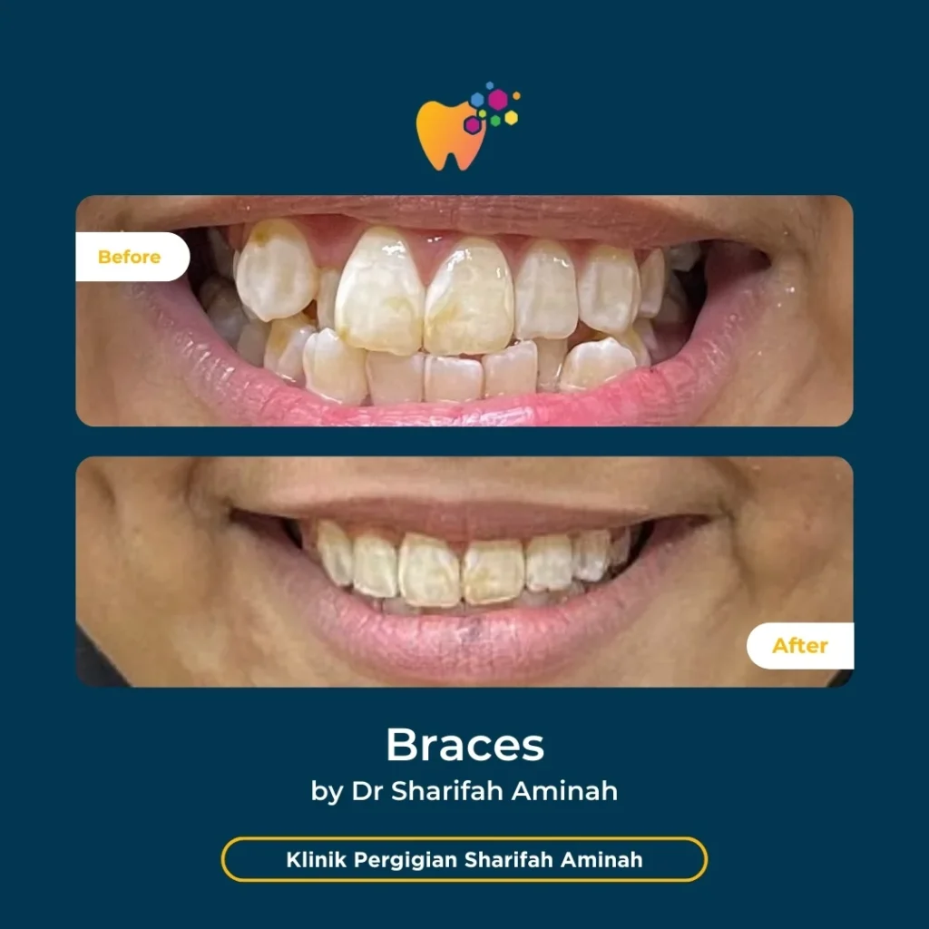 Kes rawatan braces pesakit Setiawangsa di Klinik Pergigian Sharifah Aminah menunjukkan perubahan susunan gigi sebelum dan selepas rawatan.