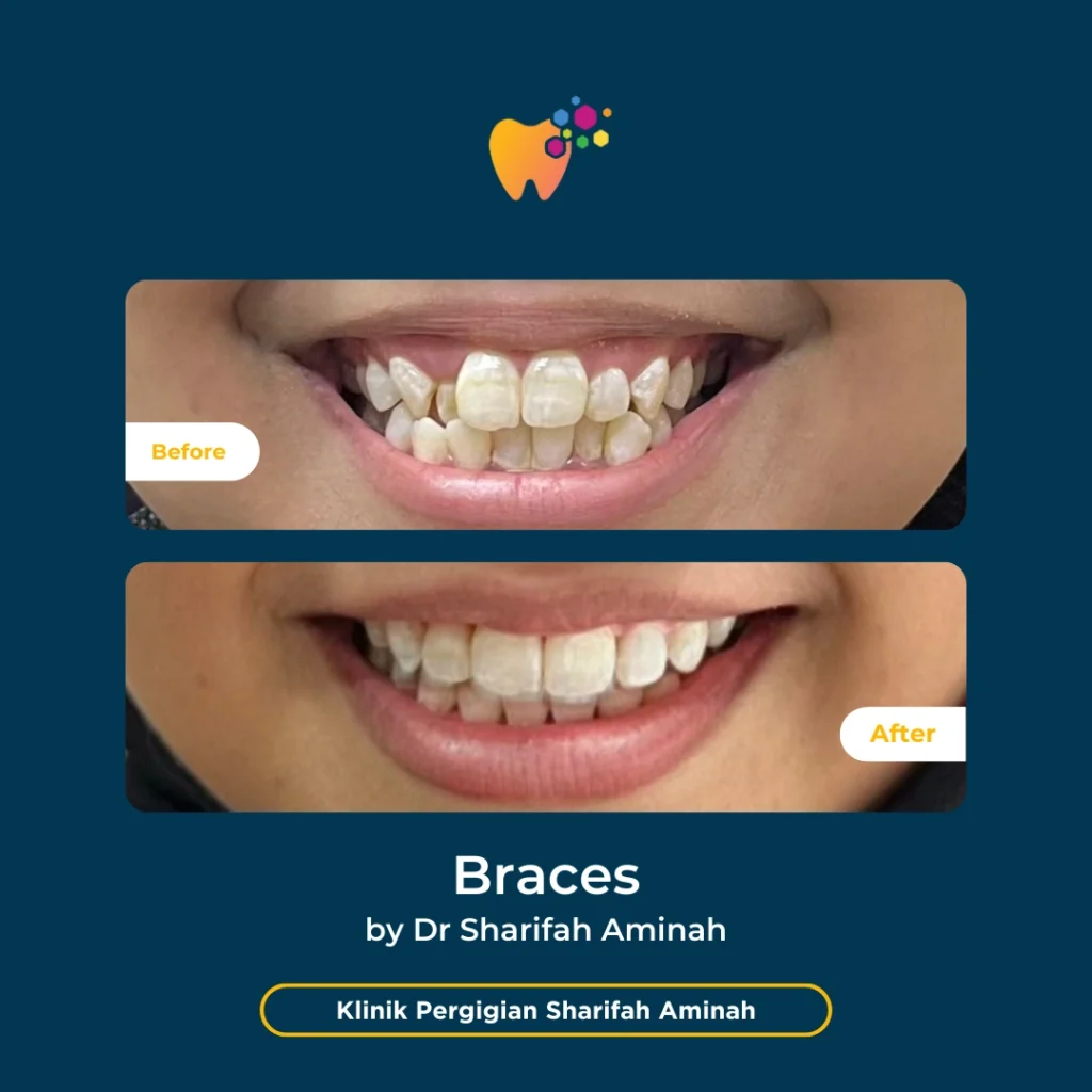Rawatan Braces (Pendakap Gigi) Wangsa Maju (LEXA) di Klinik Pergigian Sharifah Aminah