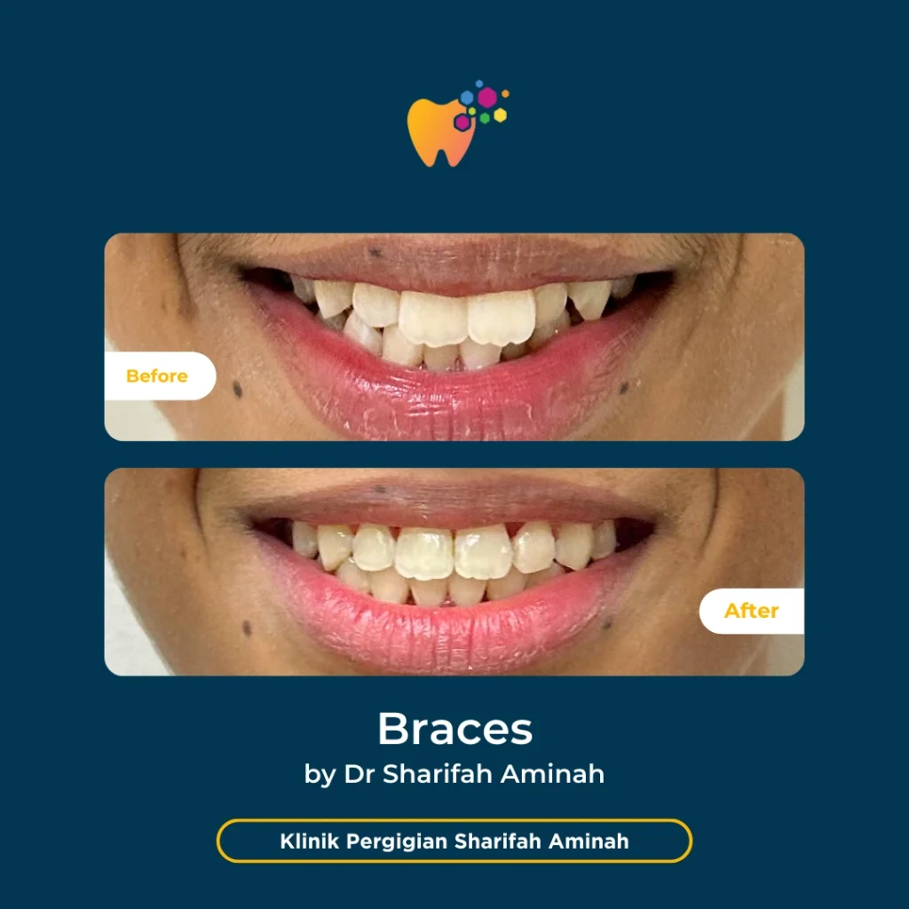 Rawatan Braces (Pendakap Gigi) Setapak di Klinik Pergigian Sharifah Aminah