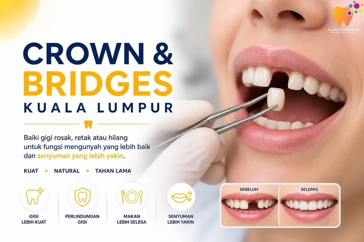 Rawatan crown dan bridge di Kuala Lumpur untuk baiki gigi rosak, retak atau menggantikan gigi hilang di Klinik Pergigian Sharifah Aminah.