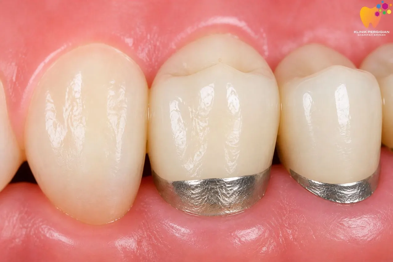 PFM crown porcelain fused to metal untuk kekuatan dan pilihan lebih ekonomi bagi rawatan crown gigi