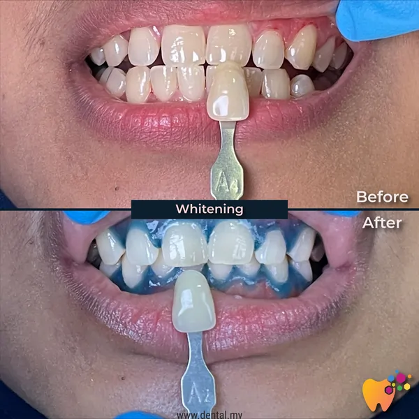 Before and after rawatan pemutihan gigi di Klinik Pergigian Sharifah Aminah