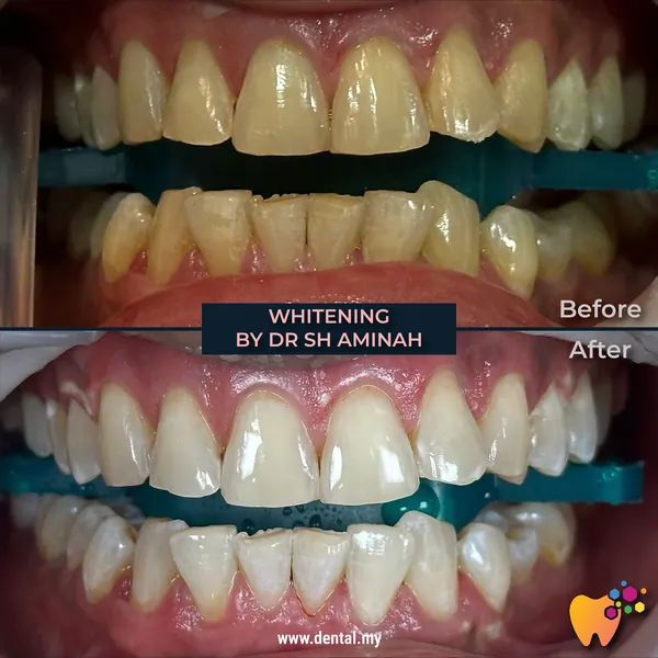 Before and after rawatan teeth whitening Kuala Lumpur oleh Dr Sharifah
