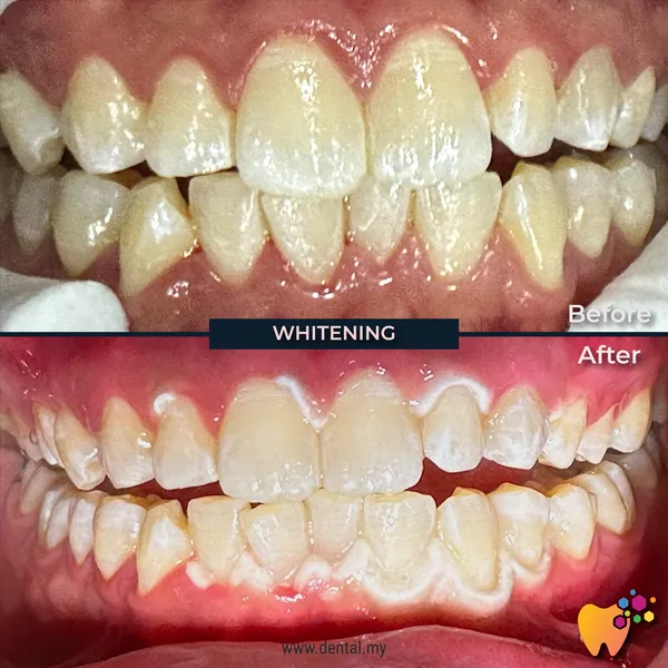 Before and after teeth whitening oleh Dr Adam Klinik Pergigian Sharifah Aminah