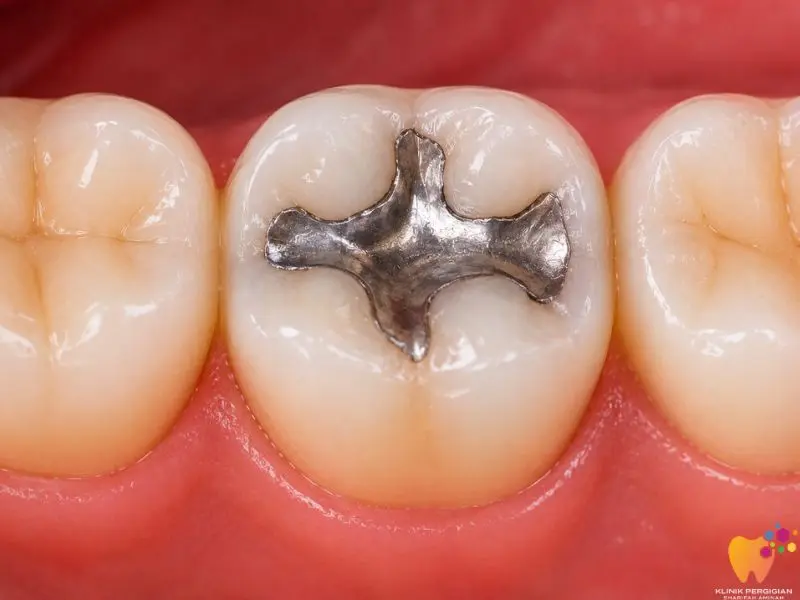 Amalgam filling untuk tampalan gigi belakang yang kuat dan tahan lama