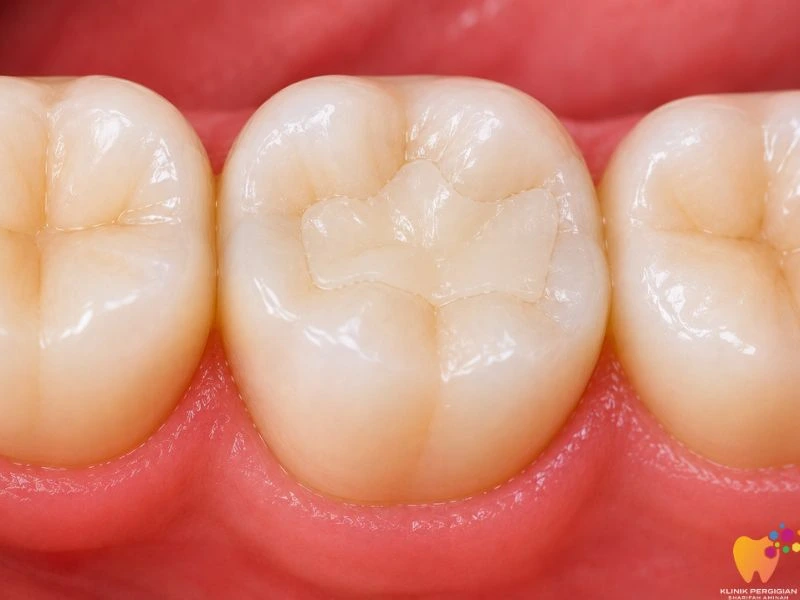 Ceramic filling untuk tampalan gigi yang lebih estetik, natural dan tahan perubahan warna