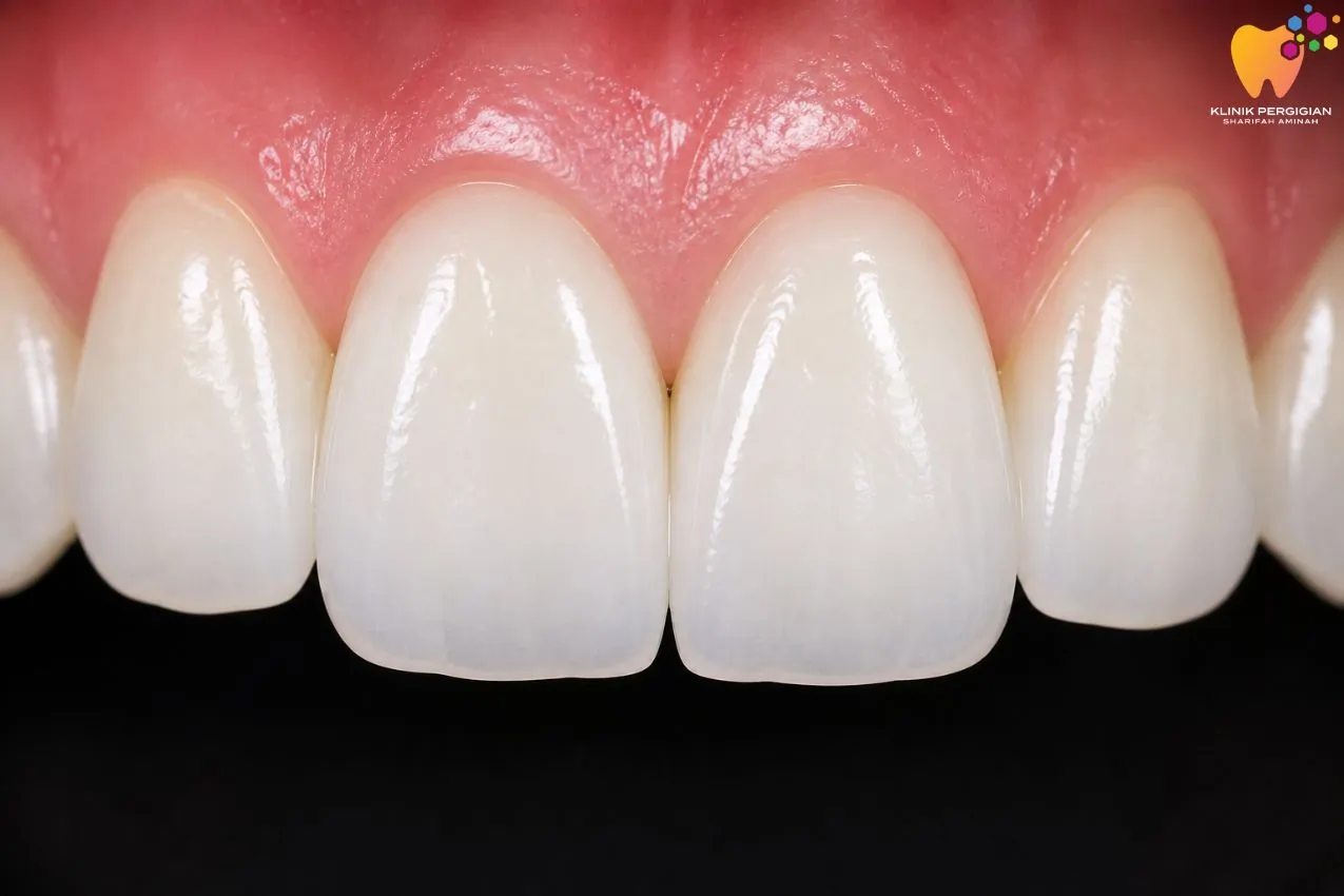 Emax crown gigi depan dengan estetik tinggi dan warna natural di klinik gigi Kuala Lumpur