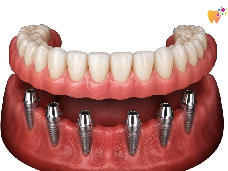 Full arch implant untuk menggantikan keseluruhan set gigi.