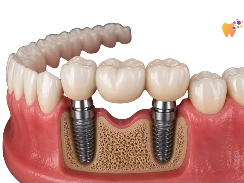 Multiple teeth implant untuk menggantikan beberapa batang gigi hilang.