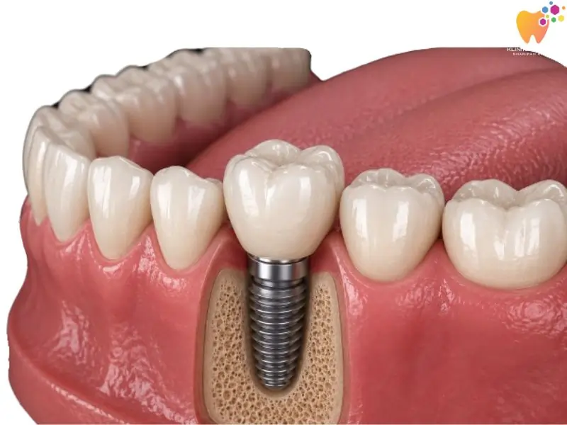 Single tooth implant untuk menggantikan satu batang gigi hilang.