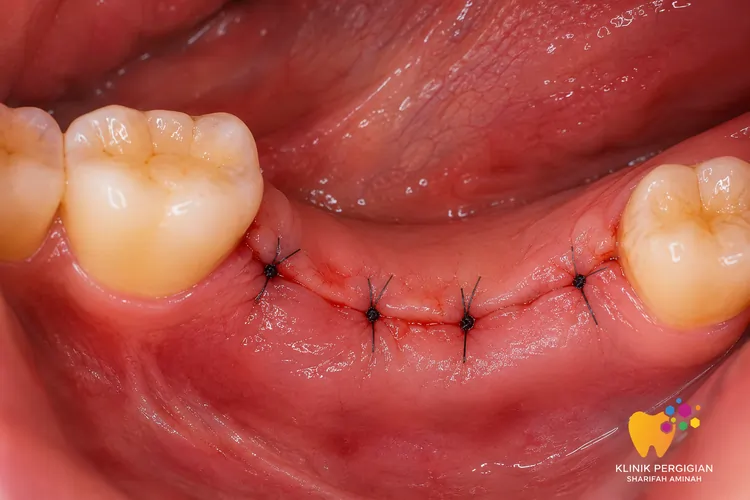 Bone Alveoplasty Kuala Lumpur