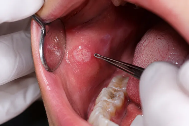 Oral Biopsy Kuala Lumpur