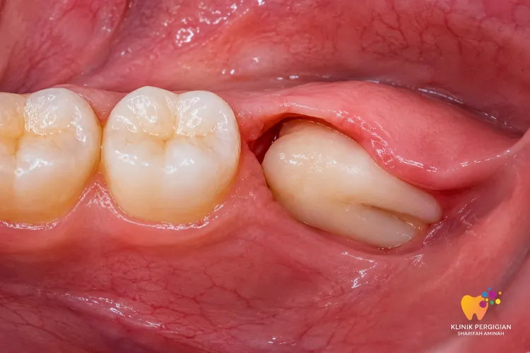Surgical Removal Impacted Teeth Kuala Lumpur