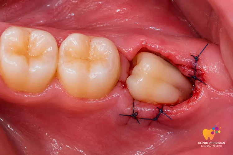 Wisdom Teeth Surgery Kuala Lumpur