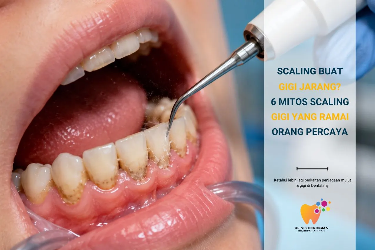Scaling Buat Gigi Jarang — Betul ke? 6 Mitos Scaling Gigi yang Ramai Orang Percaya