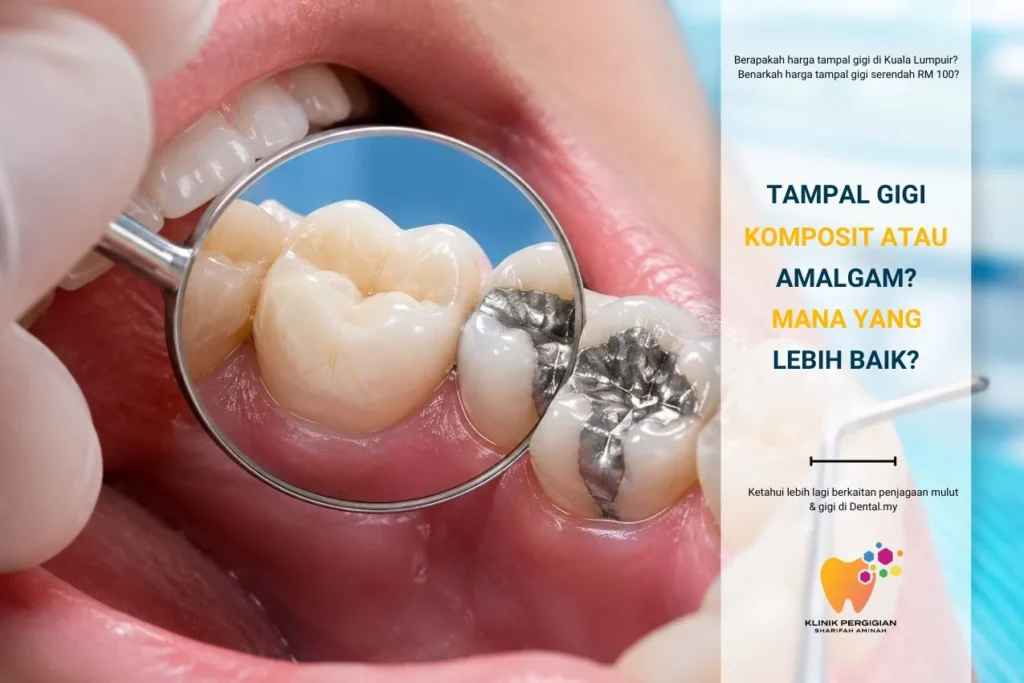Tampal Gigi — Komposit atau Amalgam? Ramai Pesakit Keliru