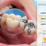 Tampal Gigi — Komposit atau Amalgam mana yang lebih baik