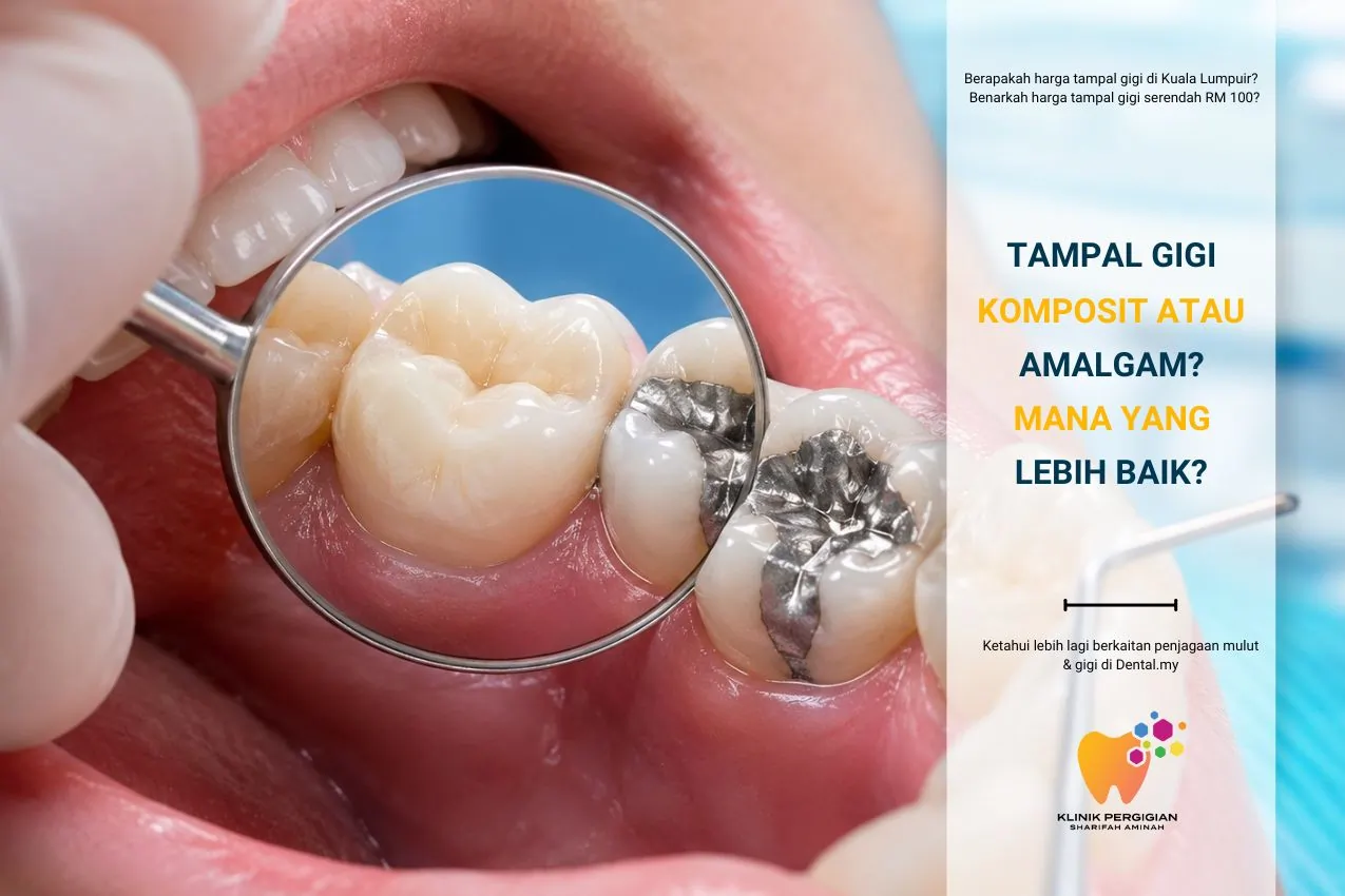 Tampal Gigi — Komposit atau Amalgam? Ramai Pesakit Keliru