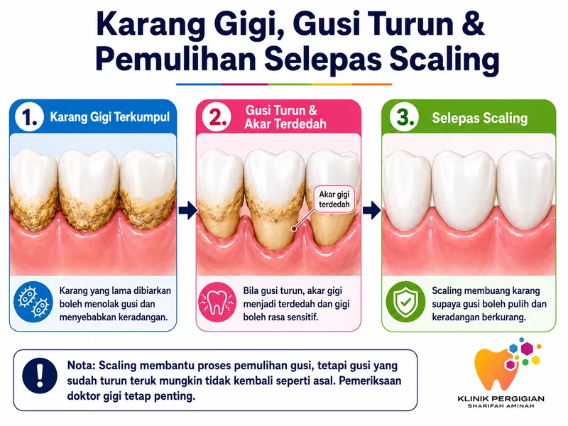 Diagram menunjukkan gusi turun akibat karang gigi dan bagaimana scaling membantu proses pemulihan gusi