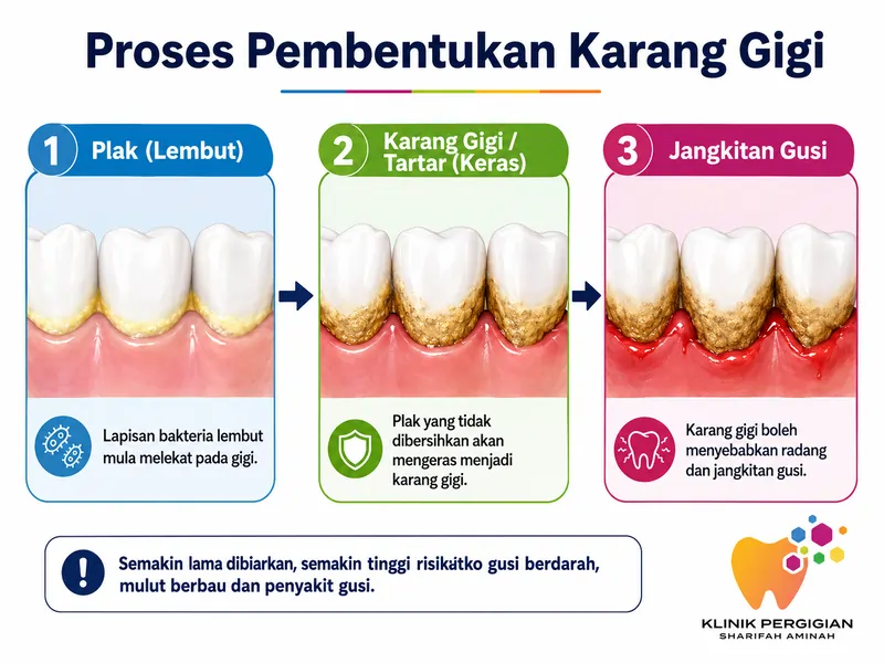 Diagram proses pembentukan karang gigi dari plak ke tartar hingga menyebabkan jangkitan gusi