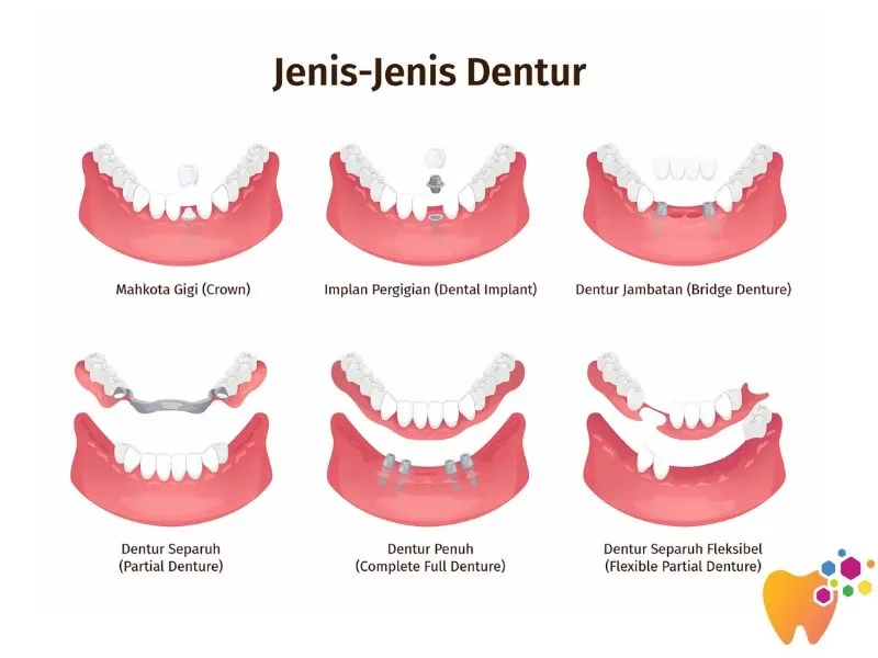 Jenis jenis dentur - Klinik Pergigian Sharifah Aminah
